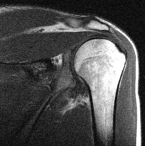 Schulter Bild 2: MRT Aufnahme einer Schulter von hinten gesehen, zeigt Oberarm und Schulterpfanne, sowie M. supraspinatus und das Schulterdach.