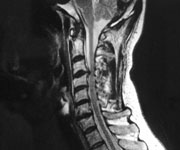 Foto: Nackenschmerzen aufgrund eines Bandscheibenvorfalls der Halswirbelsäule.Das Foto zeigt eine Kernspintomografie der HWS in seitlicher Darstellung.