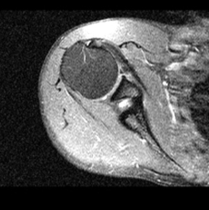 Schulter Bild 1, MRT eines Schultergelenkes im Schnitt von oben gesehen, Der Größenunterschied von kleiner Gelenkpfanne und sehr großem Oberarmkopf an der Schulter wird deutlich.